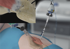 Arthroscopic Gluteus Medius Tendon Repair