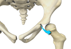 Borderline Hip Dysplasia