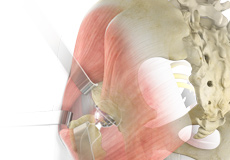 Complex Hip Reconstruction Surgery