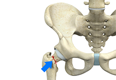 Femoral Neck Fracture