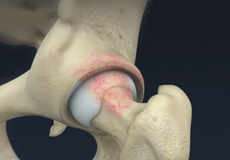Femoral Osteoplasty