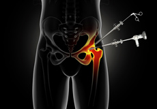 Hip Arthroscopy - Supine Position