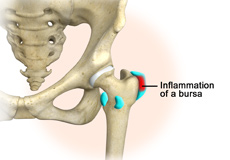 Hip Bursitis
