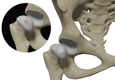 Hip Cartilage Restoration