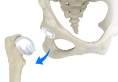 Hip Dislocation
