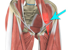 Hip Flexor Strain