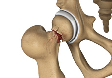Hip Injury