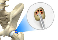 Hip Microfracture