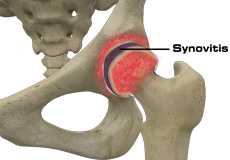 Hip Synovitis