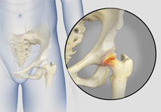 Irritable Hip