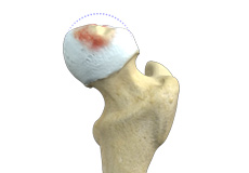 Legg-Calve-Perthes-Disease