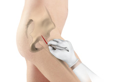 Minimally Invasive Total Hip Replacement