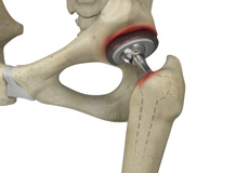 Periprosthetic Hip Infection