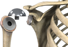 Simpliciti Canal-Sparing Total Shoulder Arthroplasty