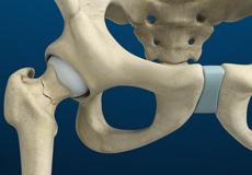 Stress Fractures of the Hip