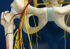 Subtrochanteric Hip Fracture