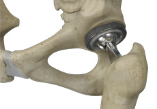 Total Hip Replacement